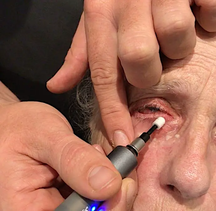 Diagnostic expression of the meibomian glands performed on the lower eyelid margin with a standardised applicator