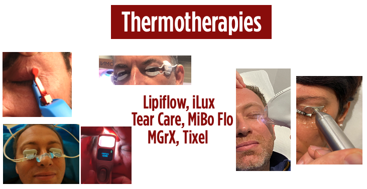 Thermotherapy platforms used in meibomian gland dysfunction: MGrX, LipiFlow, Tixel, TearCare, iLux and MiBo Flo