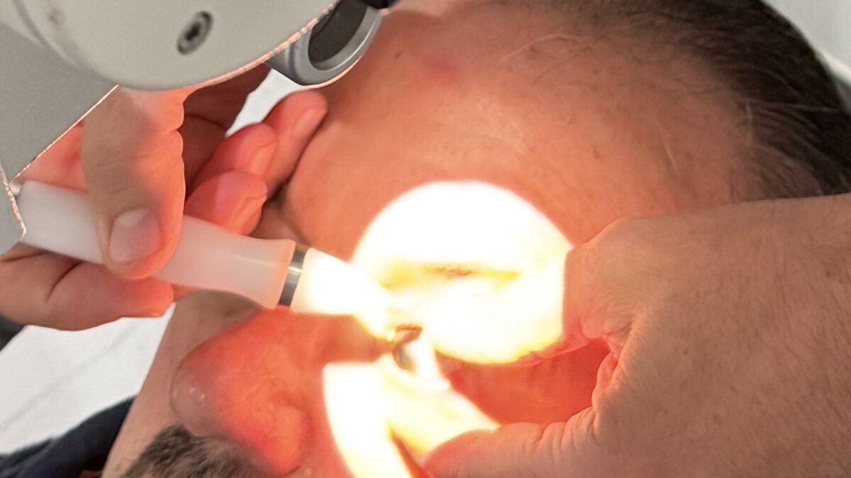 Small-diameter light guide applied to the eyelid during an IPL session
